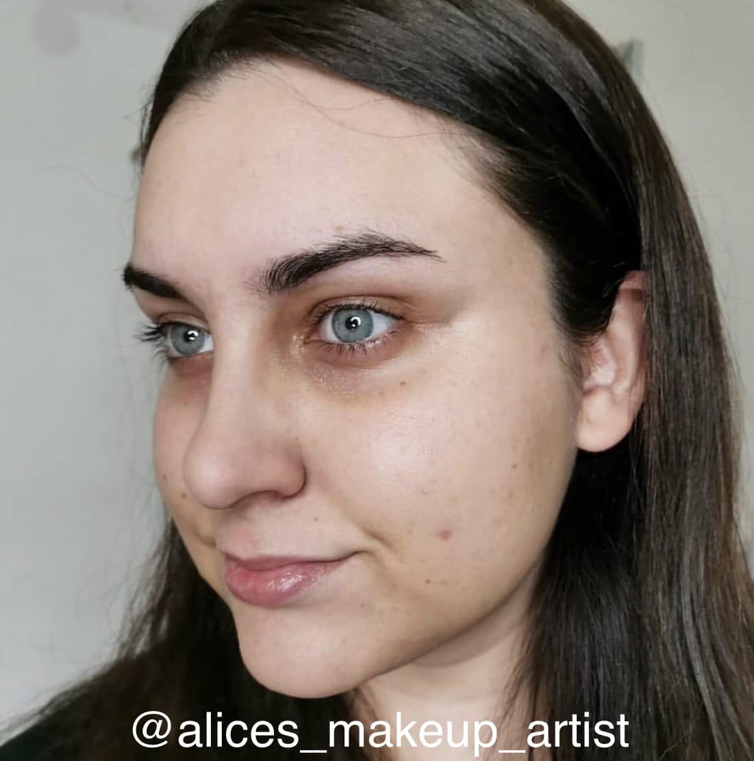 mujer con ojeras pigmentadas y hundidas