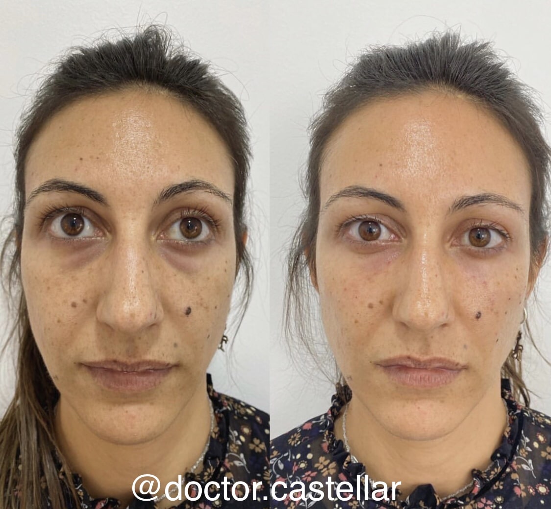 mujer con ojeras pigmentadas