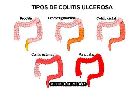 Tipos de colitis ulcerosa