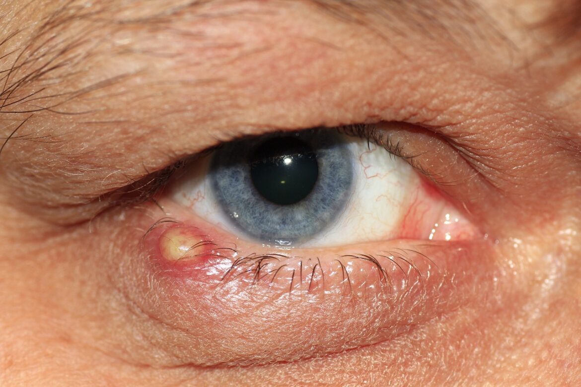 Orzuelo en el ojo: Qué es, causas, tratamiento y prevención