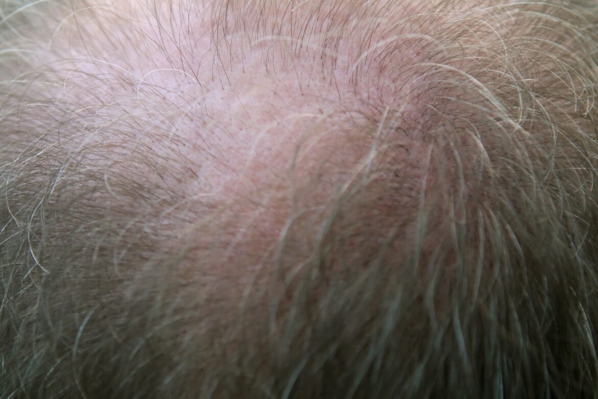 Alopecia Androgénica, tratada por tricólogos.
