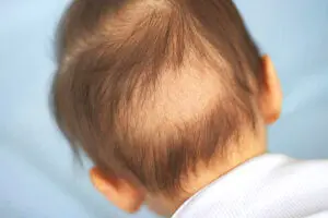 niño con alopecia