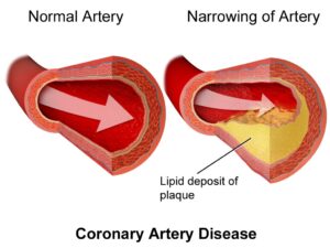 Enfermedad cardiovascular. Aterosclerosis.