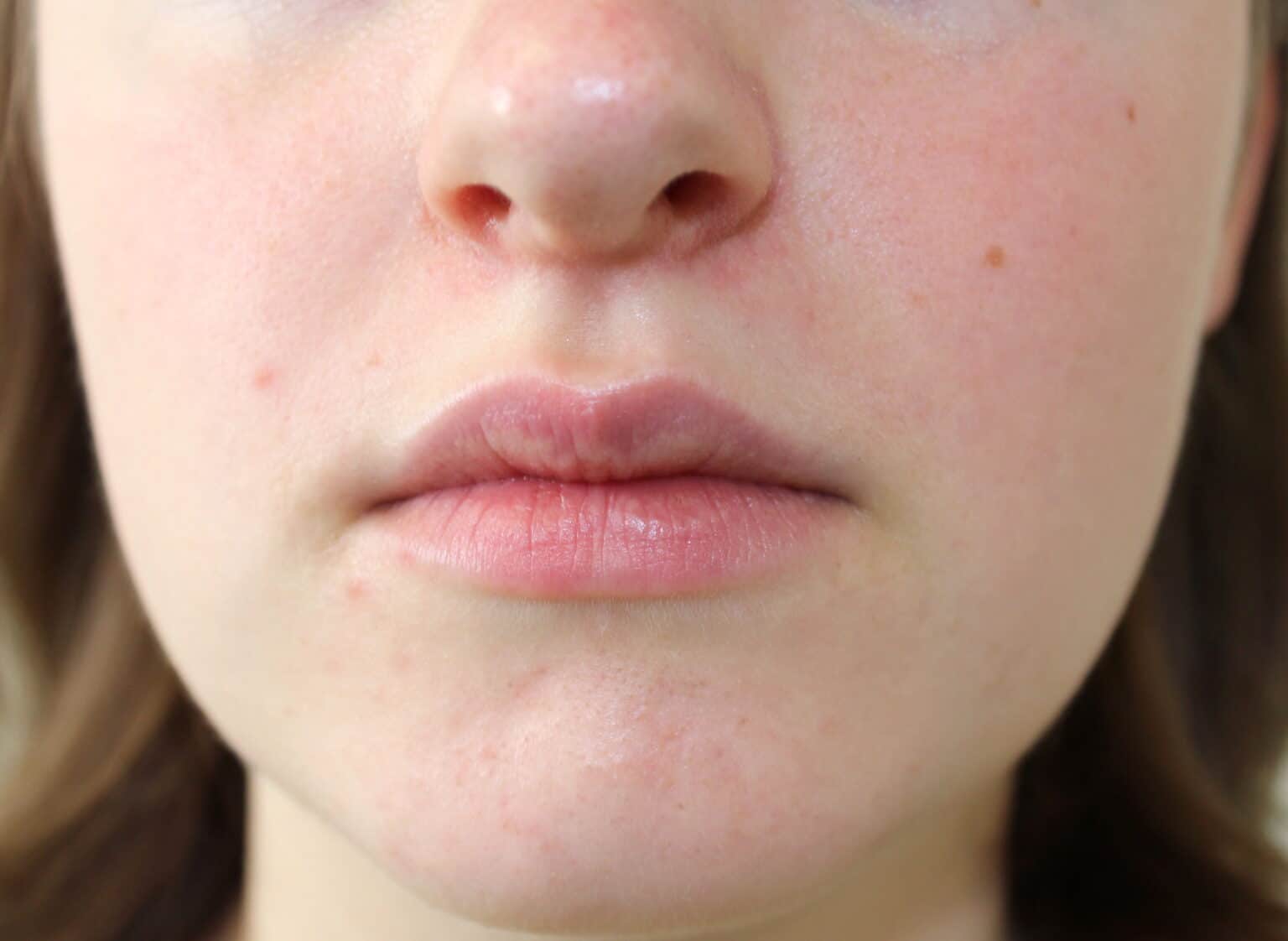 Escamas Rojas DERMATITIS SEBORREICA. Lo que debes saber. - Salud Diez