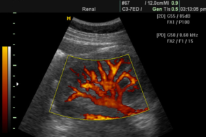 ecografía doppler resultados