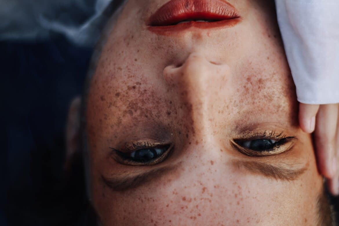 Melanoma maligno: ¿cómo distinguir los lunares peligrosos?