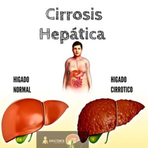 Cirrosis hepática