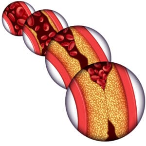 enfermedad arterial 