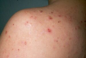 DERMATITIS HERPETIFORME