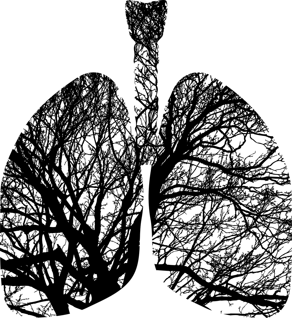 derrame pleural