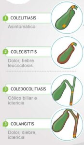 Diferencias de las patologías de la vesícula biliar 