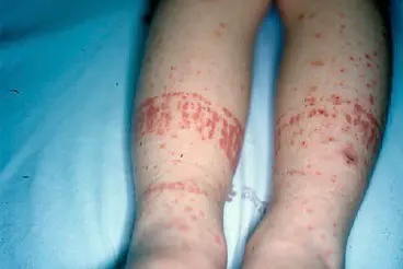 Púrpura y petequias por meningococemia. @med_descomplicada en Instagram.