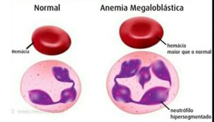 anemia megaloblastica 