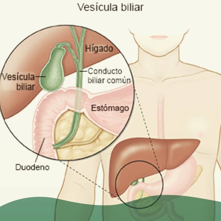 Vesícula biliar ¿colelitiasis, colecistitis, coledocolitiasis, colangitis?