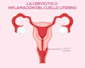 Cervicitis que es