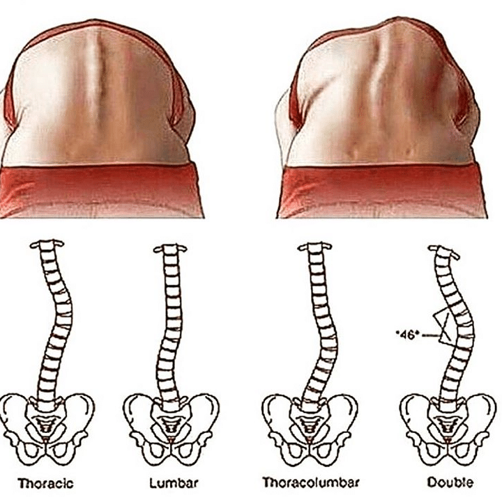 Escoliosis lumbar: Diagnostico y tratamiento - Salud Diez