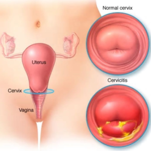 Cervicitis sintomas