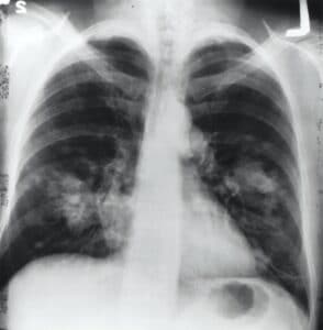 Diagnóstico de los pulmones