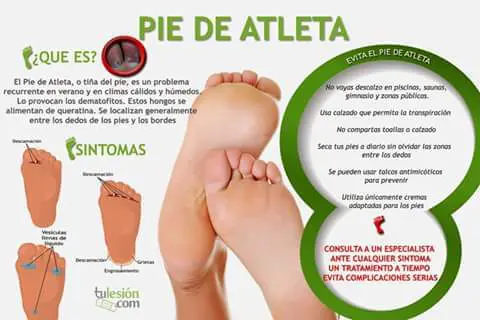 TODO SOBRE EL PIE DE ATLETA 