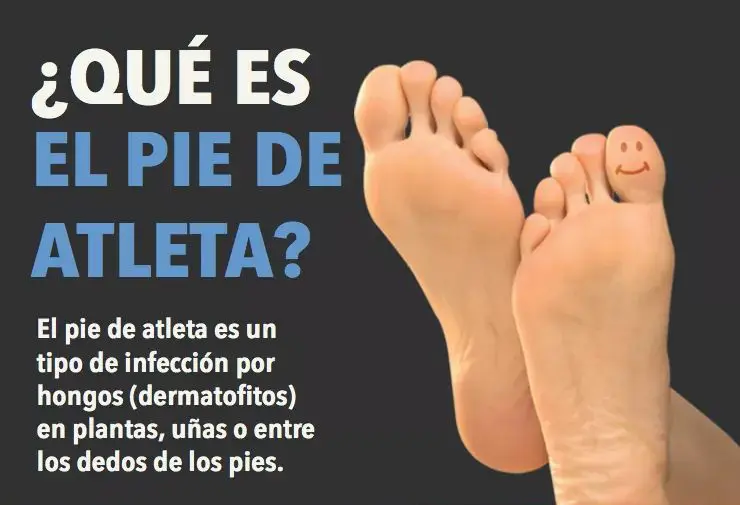 ¿QUÉ ES EL PIE DE ATLETA?
