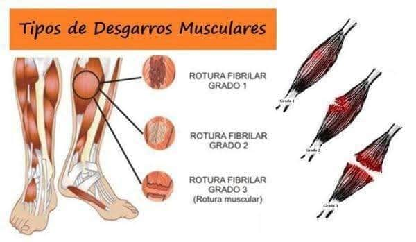 TIPOS DE DESGARRE MUSCULAR 