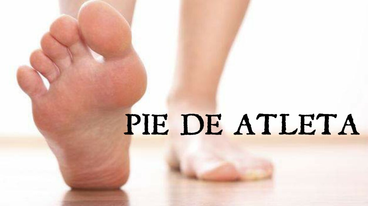 PIE DE ATLETA: Te explicamos como prevenirlo