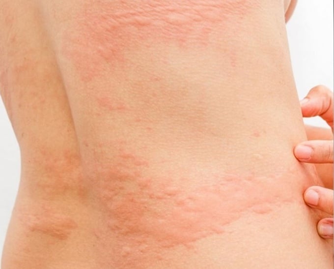 ¿Qué es la sucralosa? Urticaria: efecto secundario del consumo excesivo de sucralosa. @draclarissaprati en Instagram.