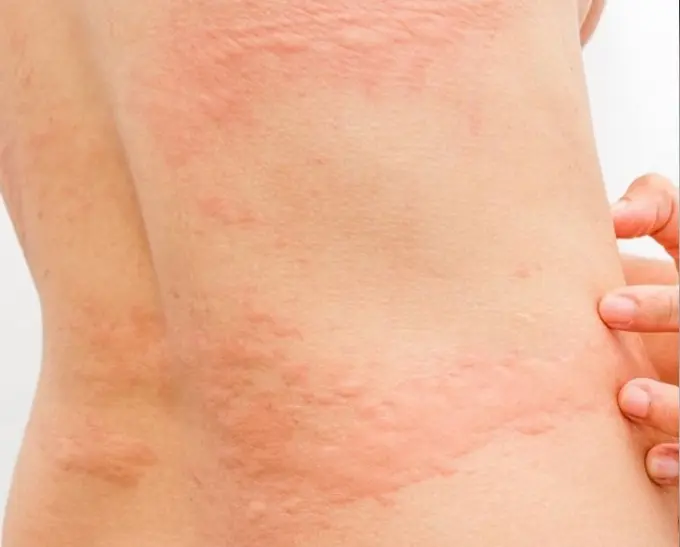 ¿Qué es la sucralosa? Urticaria: efecto secundario del consumo excesivo de sucralosa. @draclarissaprati en Instagram.