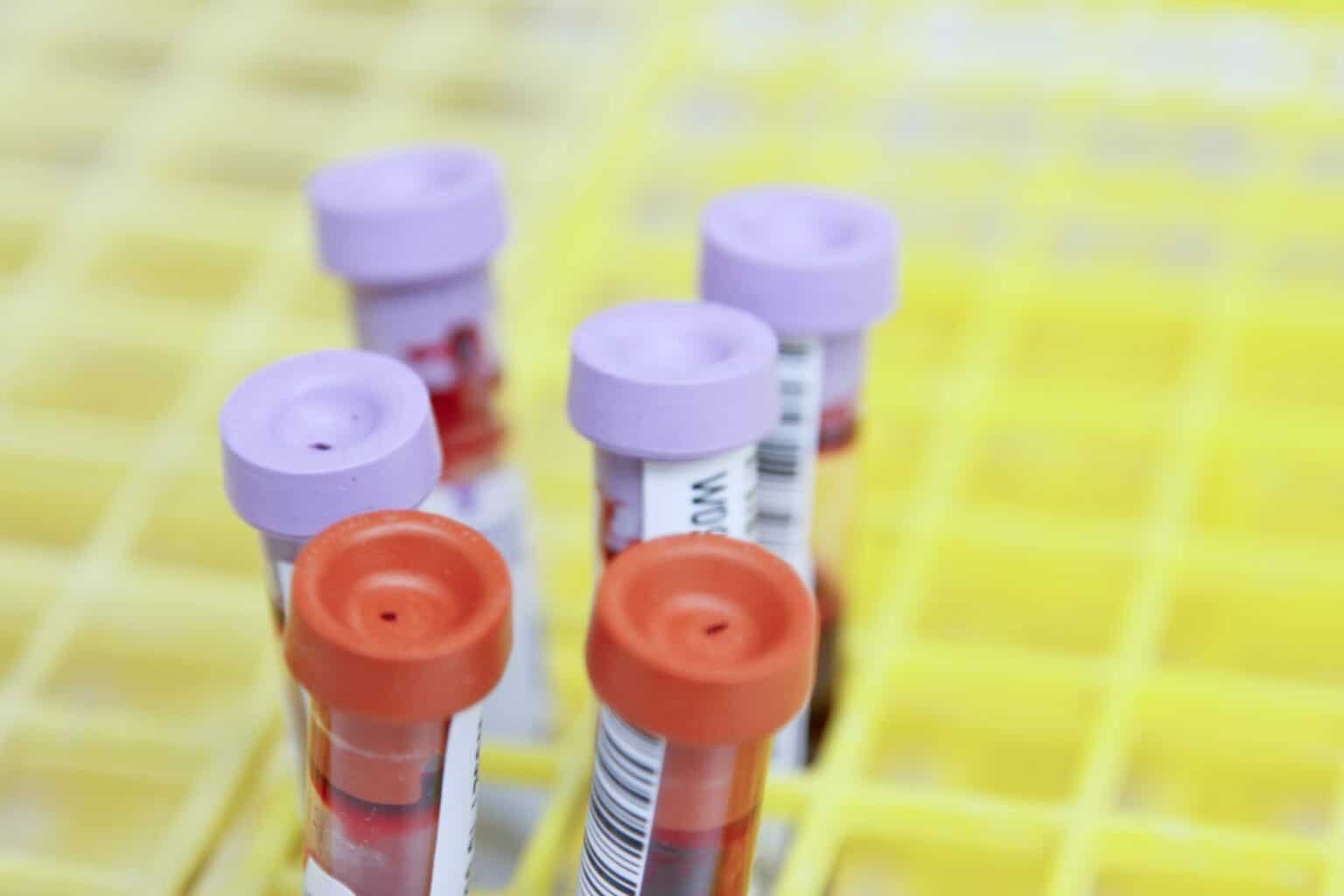 Anemia apl sica y caracter sticas importantes salud diez