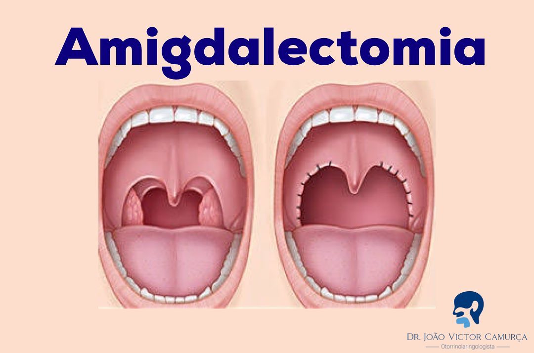 amigdalitis