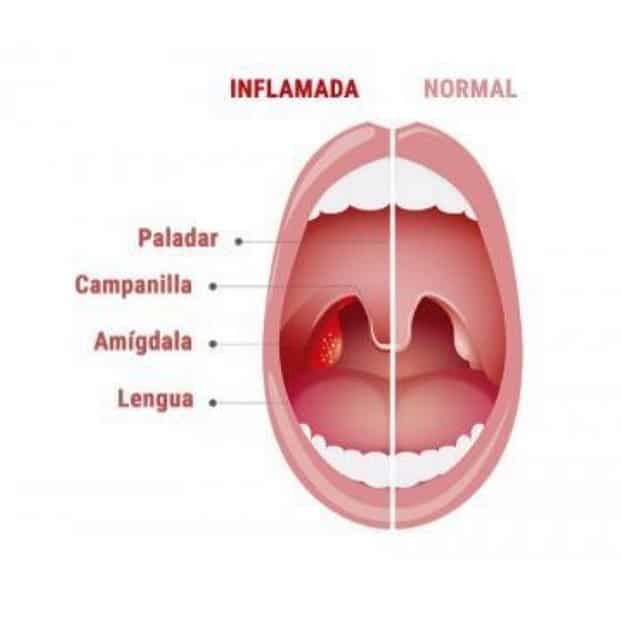 amigdalitis