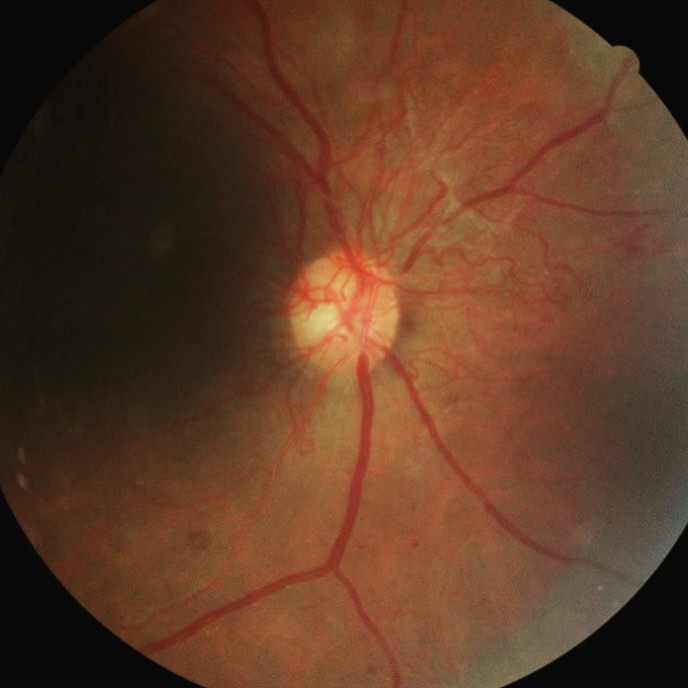 Retinopatía diabética