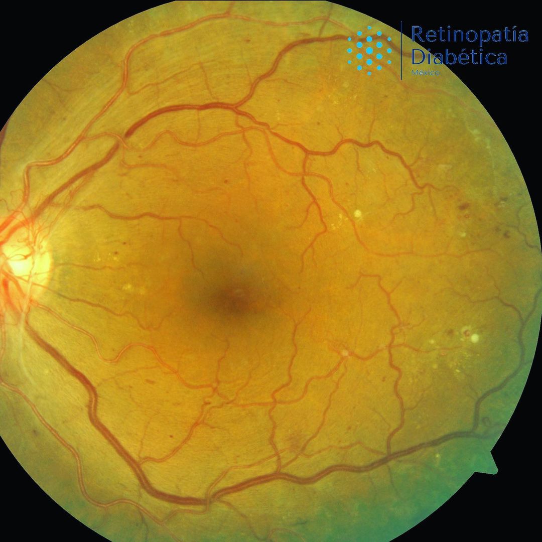 Retinopatía proliferativa